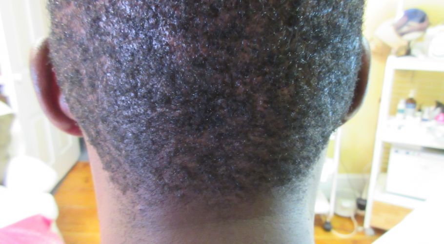 Ron after scar revision